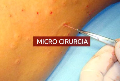 Microcirurgia