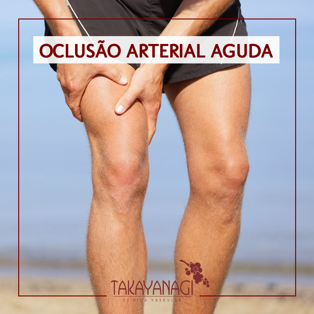 Oclusão Arterial Aguda