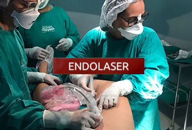 Endolaser